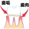 歯肉炎